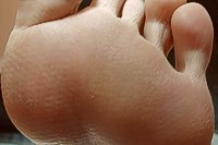 verrue après verrue après