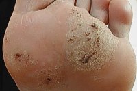 verrue avant verrue avant